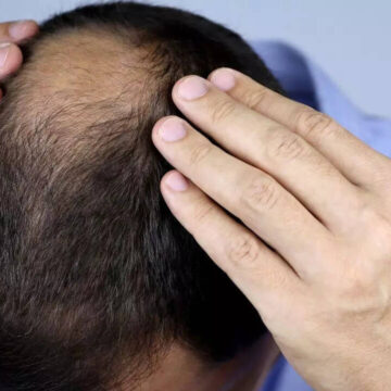 Study Links Widely Used Hair Loss Drug to Increased Risk of Suicide and Mood Disorders
