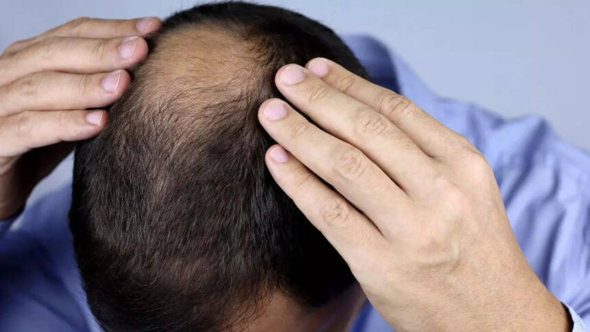 Study Links Widely Used Hair Loss Drug to Increased Risk of Suicide and Mood Disorders