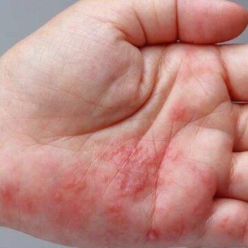 “Tomato Flu” Outbreak in Uttarakhand Raises Alarm as 28 Cases Confirmed