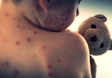 mongolia’s-total-number-of-confirmed-measles-cases-exceeds-14,000