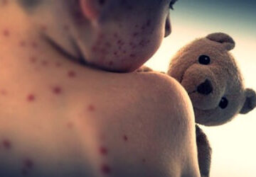 measles-outbreak-kills-143-in-bangladesh,-over-12,000-suspected-cases-reported