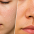 Whiteheads Vs Blackheads: What Causes These Stubborn Skin Problems and How Can You Treat Them?