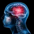 Brain Tumour Warning Signs Often Mistaken for Stress and Migraine, Veteran Neurosurgeon Urges Early Diagnosis